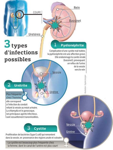 sodomie infection urinaire|Comment éviter les infections urinaires à cause de la sodomie